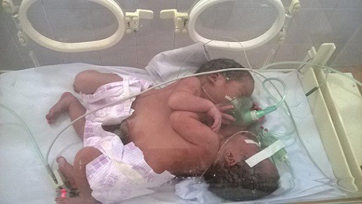 Vị Xuyên - Bác sĩ ra chợ xin từ thiện cứu 2 bé song sinh dính liền