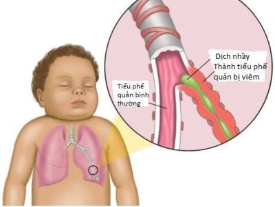 Hen phế quản ở trẻ em và cách phòng tránh